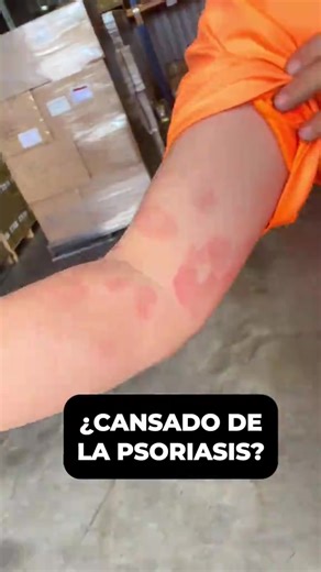 El secreto no es usar más productos, es usar el correcto 💡 PsoriCalm Spray™ se integra fácilmente a tu rutina diaria, ayudándote a mantener la piel más cómoda sin esfuerzo. Un spray, unos segundos y listo ⏱️ 👉 Hazlo parte de tu día #ecuador #psoriasis #fyp #tendencias #dermatologia