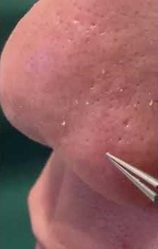 角栓を抜くだけの動画 #角栓 #角栓除去 #blackheads