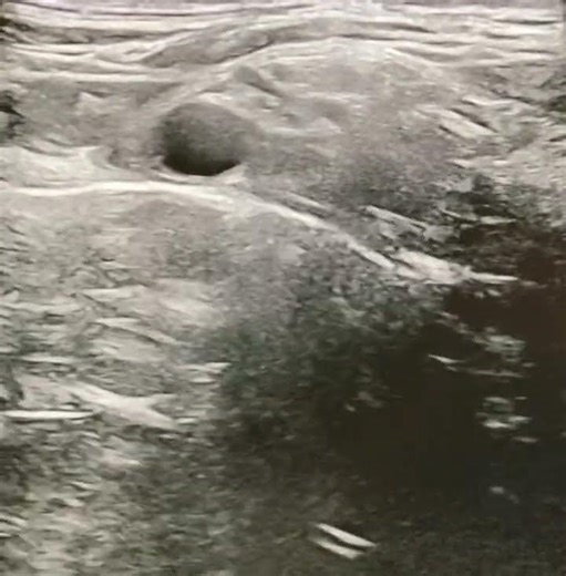 Single vs Double site Injection Ultrasound-Guided Supraclavicular Block for Upper Limb Surgery