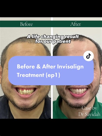 Transform Your Smile: Before & After Invisalign Treatment