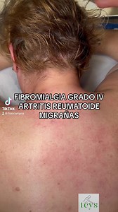 1.3M views · 5.8K reactions | FIBROMIALGIA GRADO IV, ARTRITIS REUMATOIDE, MIGRAÑAS. Paciente con furte Dolor de Espalda y Migrañas todo el día 24/7 con Anemia, problemas digestivos, Vasculitis, Artralgias y Factor Reumatoide +, que le provocan crisis de Ansiedad y Depresión porque cada dia va a peor. Tratamos con TEYS para Recuperar la Calidad de Vida ✅ #teys #fisiocampos #fibromialgia #artritisreumatoide #fisioterapeuta #fisioterapia | Francisco Campos Chica | Facebook