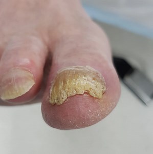 Thick Toenails: Cause, Symptoms & Treatment
