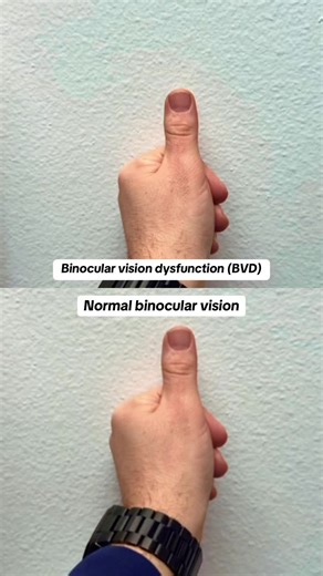 Vivid Visions Optometry, Inc on Instagram: "👀 What Normal Vision vs. BVD Looks Like When Switching Focus Between Eyes 👀 🔹 Normal Vision: The image stays in the same place when you switch focus between eyes. 🔹 BVD: The image jumps—it may shift diagonally, horizontally, or vertically, depending on your eye misalignment. If you notice: ➡️ Right eye’s image moves up and to the left → You likely have right hypotropia & right exotropia ➡️ Left eye’s image moves up and to the left → You likely have