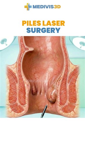 Laser Surgery for Piles (Hemorrhoids) Explained | 3D Medical Animation | Painless Piles Treatment