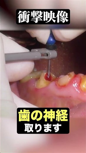 【貴重映像】歯の神経取ります #歯医者 #Youtuber #ザホワイトデンタルクリニック