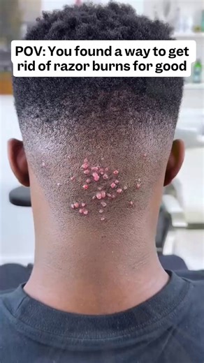 POV: razor burn  The FlexSeries®, smooth gentle scalp shaves! | Freebird | Facebook
