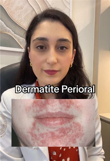 O que é Dermatite Perioral e Como Tratar?