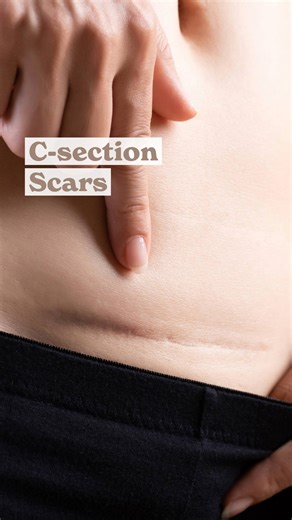 Hannah & Emma | C-section & Postpartum experts on Instagram: "What does a C-section scar really look like? Every scar heals differently, and C-section scars can vary in colour, size, and texture. Here are just a few real-life examples we’ve seen in our clinic. If your C-section scar doesn’t look like these, don’t worry - that doesn’t mean it’s unusual. Scars heal uniquely, and we simply don’t have enough photos to show the full range. 💌 Want to help other mums who might be worried? Email us a p