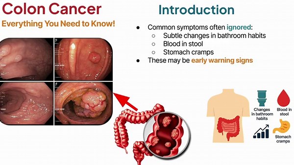 Colon Cancer Signs & Symptoms Most People Ignore - Intestinal Cancer Warning Signs