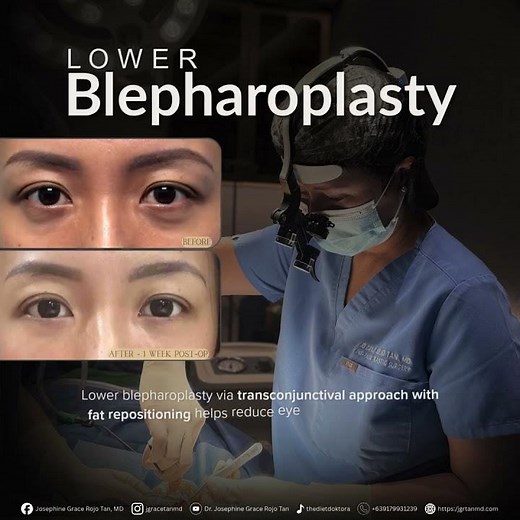 Lower Blepharoplasty (transconjuctival + fat repositioning)