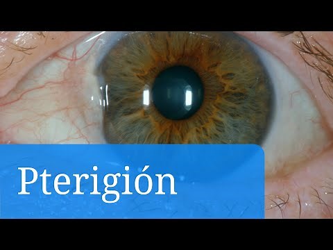 Pterigión: vea fotos y infórmese sobre el tratamiento mediante gotas y cirugía