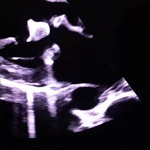 infective endocarditis, mitral valve vegetations.
