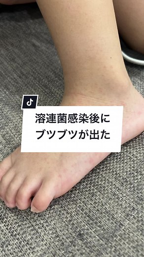 スタッフの息子さんの足のぶつぶつ発疹😭溶連菌が原因？ 治療上で大事なことは？🤔 息子さんの足の写真で診察しました☺️ #皮膚科 #美容皮膚科 #溶連菌 #寝屋川 #香里園 #寝屋川皮膚科