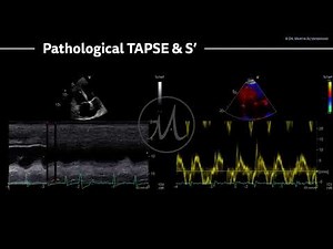 〖Echocardiography〗 Pathological S' & TAPSE