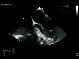 Severe Aortic Valve Regurgitation • Video • MEDtube.net