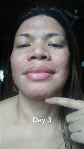 CO2 Fractional Laser Before & After #co2 #laser #skincare #face
