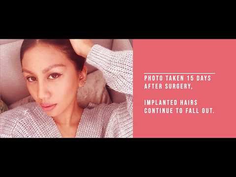3 Months Eyebrow Transplant | Full Procedure | Before & After | Journey update