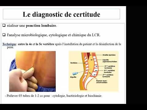 Méningites de l'enfant Pr Bouchetara