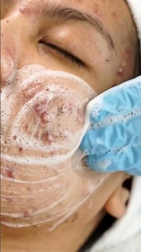 The Ultimate Foam Facial for a Deep Cleanse