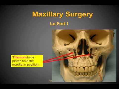Maxillary Mandibular Advancement for Obstructive Sleep Apnea Dr Robinson Part I