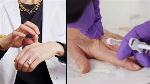 Dermatologist explains how hand filler works