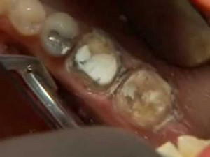 Premier Traxodent Hemodent Paste Retraction System Retraction Cap Technique 1