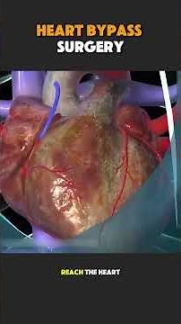 How Heart Bypass Surgery Is Performed | CABG Surgery Explained Step by Step #heartsurgery