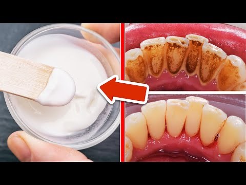 Das BESTE Hausmittel zur Entfernung von Zahnstein, Karies und Plaque🤯💥
