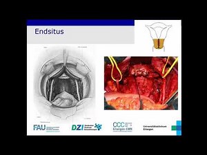 DZI Webinar “Immunotherapy for Uterine & Cervical Cancer”, June 16, 2021