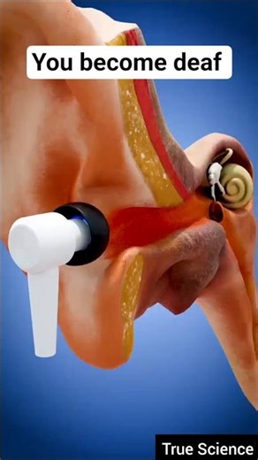 🔊👂 How Loud Music Through Earbuds Causes Permanent Hearing Loss & Tinnitus 😵‍💫#zackdfilms