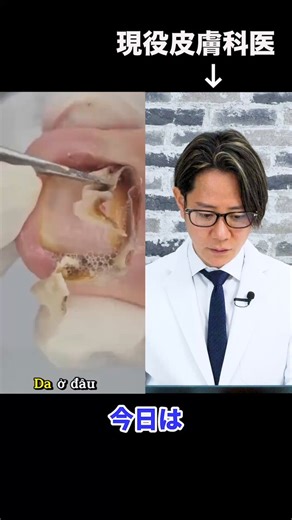 痛々しいこの映像…これは何をしているんですか⁉️皮膚科医が解説します💡