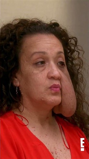 Yamile lives a fulfilling life despite growing up with a tumor #botched