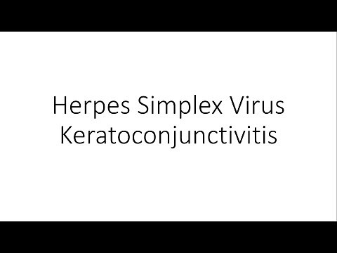 Herpes Simplex Virus Keratoconjunctivitis - Ophthalmology