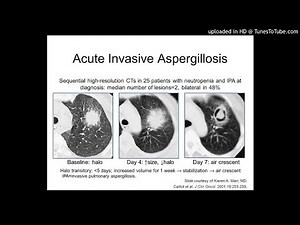 Pathogenesis and Pathology of Invasive Aspergillosis