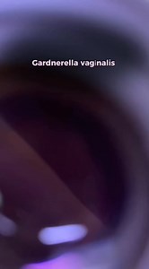 Bacterial Vaginosis (BV) 🦠👩‍⚕️ A common condition in women of reproductive age, bacterial vaginosis is linked with preterm labor and premature rupture of membranes 🤰⚠️. Gardnerella vaginalis is the primary culprit 🚨, although many anaerobic bacteria are involved too. BV lacks classic inflammation, making it a “nonspecific” vaginitis. 🔬 Clue cells—vaginal epithelial cells coated with Gram-variable bacilli...are a key microscopic finding. Vaginal discharge has a distinct “fishy” odor and a pH