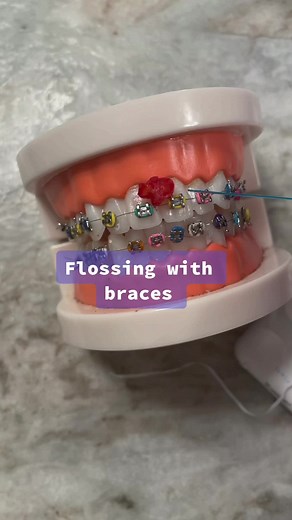 How to Floss with Braces: A Step-by-Step Guide