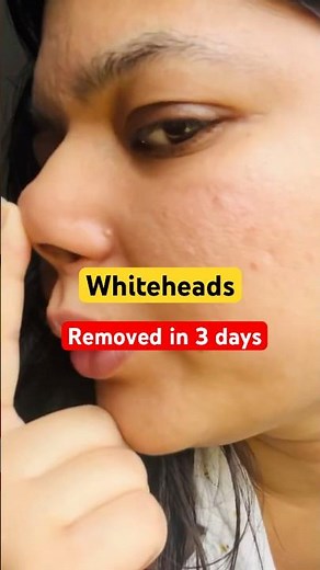 How I get rid of whiteheads in Just 3 Days | Deconstruct Pore Control Serum | Serum for acne #shorts