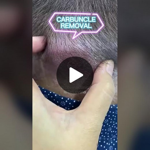 Pembedahan Carbuncle: Penjelasan & Prosedur