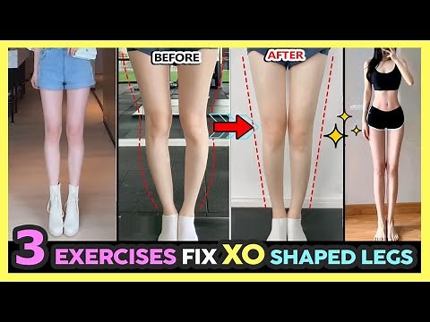 🔥ONLY 3 EXERCISES TO FIX XO Shaped legs | Get straight legs, perfect legs shape fast and easy