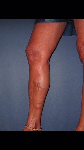 ✨Before & After✨ These patients all had a Endovenous Laser Ablation for their painful varicose veins🤩 #varicoseveins #veins #beforeandafter #fyp