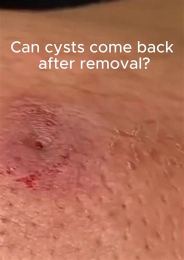 Can Cyst Come Back After Removal? Let's discuss in the comment section! #oddlysatisfying #satisfyingvideo #pimplepopping #backacne #skincaretips #blackheads #blackheadremoval #pimple #pimpleproblem #smoothskin #satisfyingvideos #acneproblems #beautytalk #beautproblems #smoothskin #cyst #cystremoval If you have INGROWN HAIR, ECZEMA, ACNE, CYSTS BLEMISHES, PURIFY BAR of HueVine Wellness and Medspa is your answer! Shop Now: https://www.huevine.com/products/purify