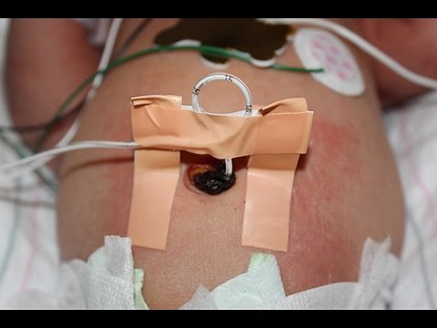 NICU Procedures: Bridge for securing umbilical venous and arterial catheters
