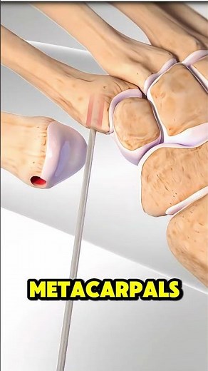 Base Of The Thumb Surgery (3d animation)