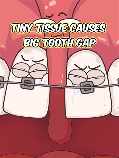The Impact of Tiny Tissues on Tooth Gaps