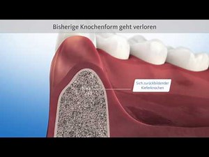 Knochenaufbau nach Zahnverlust (Socket, ridge preservation)