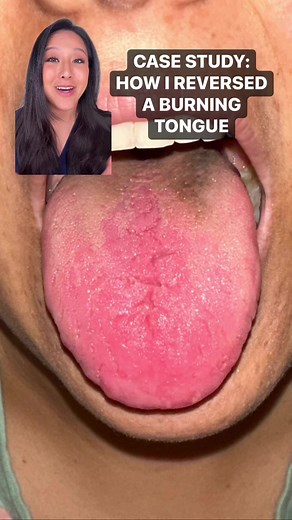 A case of a burning tongue #CaseStudy #burningtongue #digestivehealth #stomachproblems #chineseherbalmedicine #chinesemedicine #HowtoHeal #guthealthchangeseverything | Dr. Eileen Li