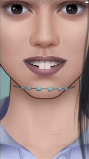 The procedure is called coronoplasty for front teeth 🪥