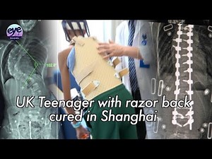 Shanghai doctors perform successful surgery on British teen with 'folded spine' condition