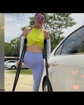 The beautiful woman is an amputee. Her entire leg was amputated from above the hip #amputee