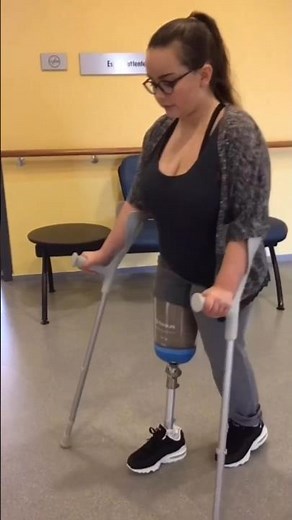 Below Knee Amputee Walks Naturally Again | Prosthetic Leg Gait Training Transformation